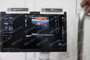 청맥병원 하지정맥류 혈관초음파 검사 대복재정맥 역류 0.5초 이상 지속 소견